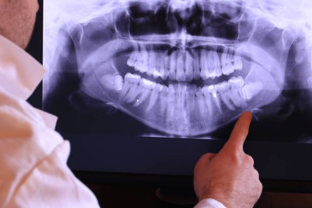 Best Emergency Wisdom Teeth Removal in Colon, MI
