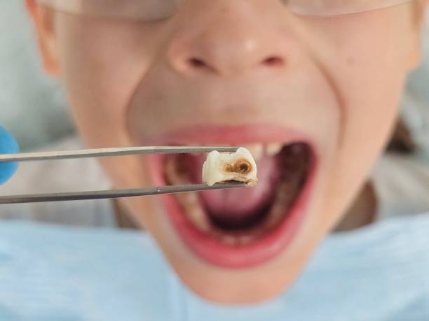 Best Emergency Treatment for Toothache in Colon, MI